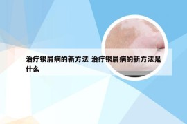 治疗银屑病的新方法 治疗银屑病的新方法是什么