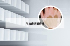 牛皮癣消褪奇痒