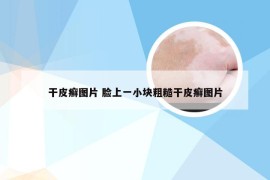 干皮癣图片 脸上一小块粗糙干皮癣图片