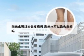 淘米水可以治头皮癣吗 淘米水可以治头皮癣吗