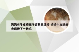 妈妈有牛皮癣孩子容易患湿疹 妈妈牛皮肤癣会遗传下一代吗