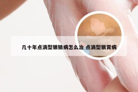 几十年点滴型银销病怎么治 点滴型银霄病