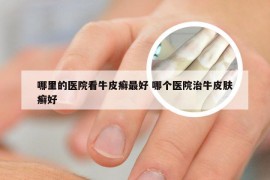 哪里的医院看牛皮癣最好 哪个医院治牛皮肤癣好