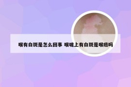 喉有白斑是怎么回事 喉咙上有白斑是喉癌吗