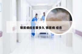 银屑病痊愈要多久 银屑病 痊愈