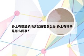 身上有褶皱的地方起癣要怎么办 身上有褶子是怎么回事?