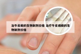 治牛皮癣的生物制剂价格 治疗牛皮病癣的生物制剂价格