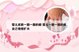 婴儿皮肤一圈一圈的癣 婴儿一圈一圈的癣 自己慢慢扩大