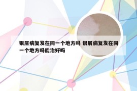 银屑病复发在同一个地方吗 银屑病复发在同一个地方吗能治好吗