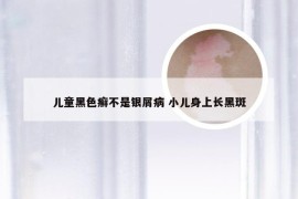 儿童黑色癣不是银屑病 小儿身上长黑斑