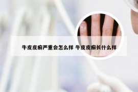 牛皮皮癣严重会怎么样 牛皮皮癣长什么样