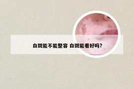 白斑能不能整容 白斑能看好吗?