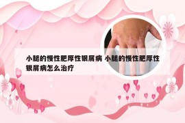 小腿的慢性肥厚性银屑病 小腿的慢性肥厚性银屑病怎么治疗