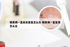 银屑病一直反反复复怎么办 银屑病一直复发怎么冶