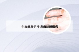 牛皮癣鼻子 牛鼻癣能断根吗