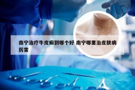 南宁治疗牛皮癣到哪个好 南宁哪里治皮肤病厉害