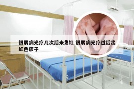 银屑病光疗几次后未发红 银屑病光疗过后出红色疹子