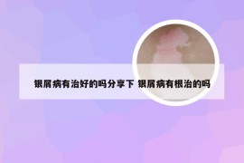 银屑病有治好的吗分享下 银屑病有根治的吗