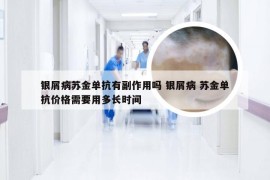 银屑病苏金单抗有副作用吗 银屑病 苏金单抗价格需要用多长时间