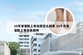 16月宝宝脸上有白斑怎么回事 16个月宝宝脸上有白色斑块