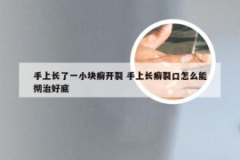 手上长了一小块癣开裂 手上长癣裂口怎么能彻治好底