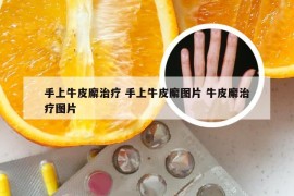 手上牛皮廨治疗 手上牛皮廨图片 牛皮廨治疗图片