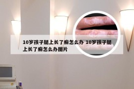 10岁孩子腿上长了癣怎么办 10岁孩子腿上长了癣怎么办图片