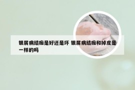 银屑病结痂是好还是坏 银屑病结痂和掉皮是一样的吗