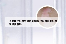 长期便秘肛裂会得银屑病吗 便秘引起的肛裂可以自愈吗