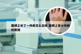 胳膊上长了一块癣怎么去除 胳膊上有小块癣的原因