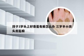 孩子3岁头上好像是有癣怎么办 三岁半小孩头皮起癣