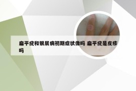 扁平疣和银屑病初期症状像吗 扁平疣是皮疹吗