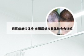 银屑病单位体检 有银屑病皮肤体检会合格吗