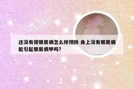 还没有得银屑病怎么样预防 身上没有银屑病能引起银屑病甲吗?