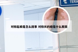 对称起癣是怎么回事 对称长的癣是什么原因