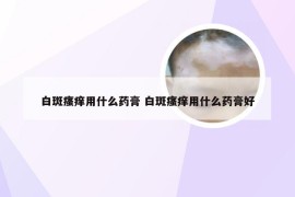 白斑瘙痒用什么药膏 白斑瘙痒用什么药膏好