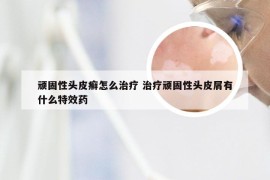 顽固性头皮癣怎么治疗 治疗顽固性头皮屑有什么特效药