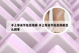 手上等关节处出现癣 手上等关节处出现癣怎么回事