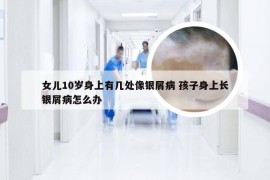 女儿10岁身上有几处像银屑病 孩子身上长银屑病怎么办