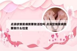 点滴状银屑病需要做活检吗 点滴型银屑病需要做什么检查