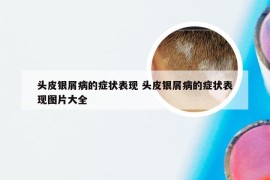 头皮银屑病的症状表现 头皮银屑病的症状表现图片大全