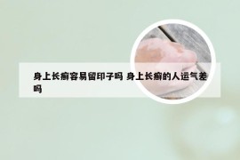 身上长癣容易留印子吗 身上长癣的人运气差吗