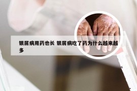 银屑病用药也长 银屑病吃了药为什么越来越多