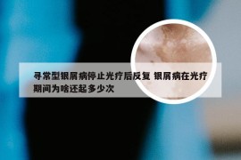 寻常型银屑病停止光疗后反复 银屑病在光疗期间为啥还起多少次