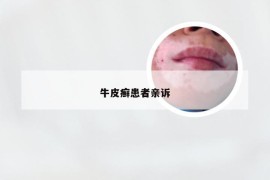 牛皮癣患者亲诉