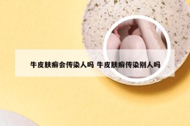 牛皮肤癣会传染人吗 牛皮肤癣传染别人吗