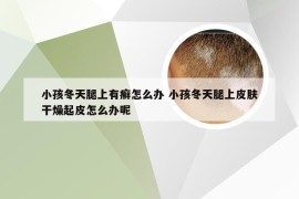 小孩冬天腿上有癣怎么办 小孩冬天腿上皮肤干燥起皮怎么办呢