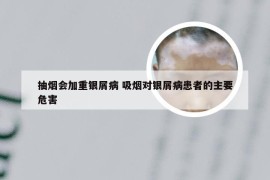 抽烟会加重银屑病 吸烟对银屑病患者的主要危害