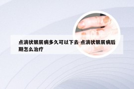 点滴状银屑病多久可以下去 点滴状银屑病后期怎么治疗