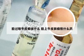 脸过敏牛皮癣抹什么 脸上牛皮肤癣擦什么药